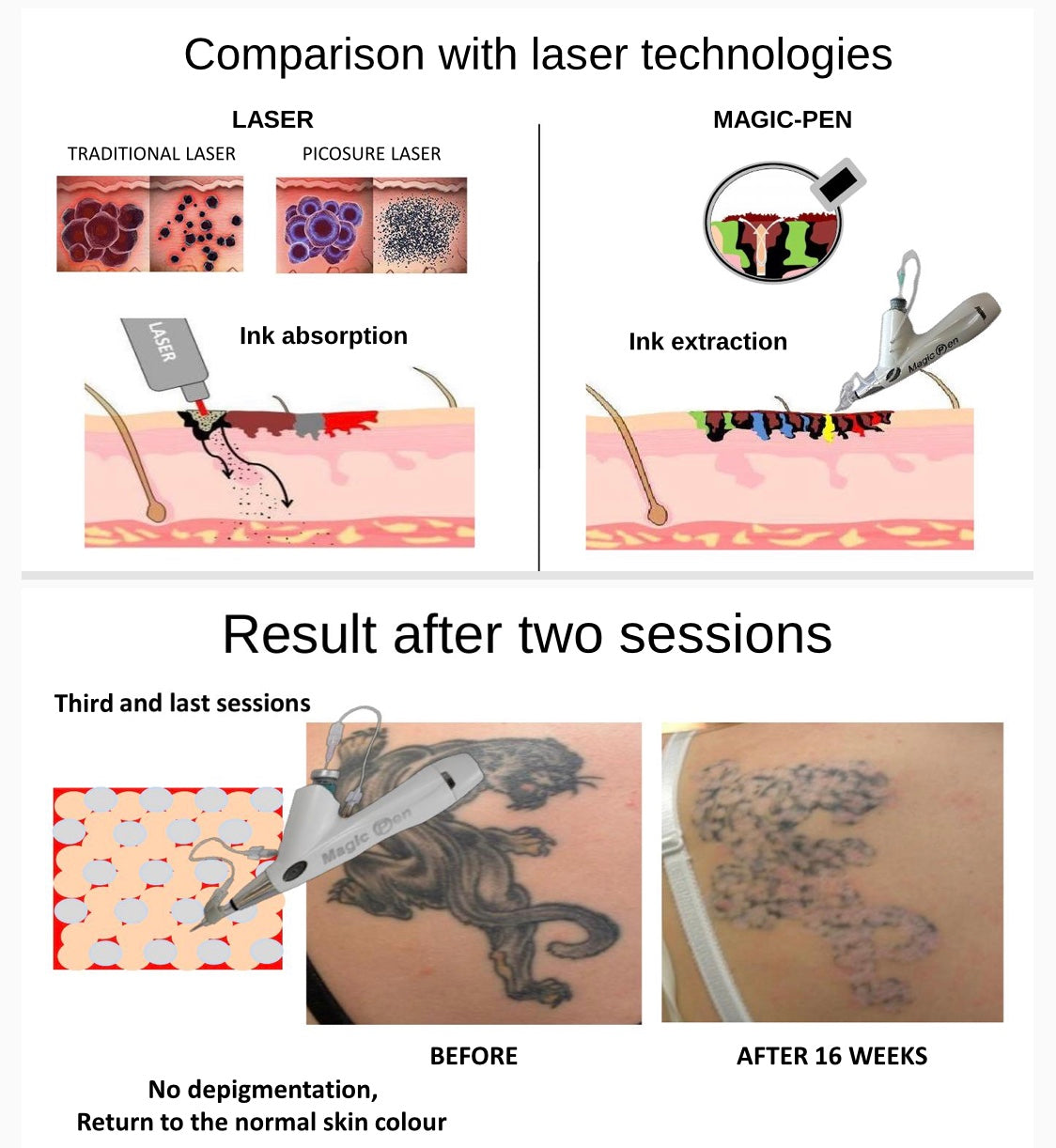 Magic Pen Tattoo Ink Extractor